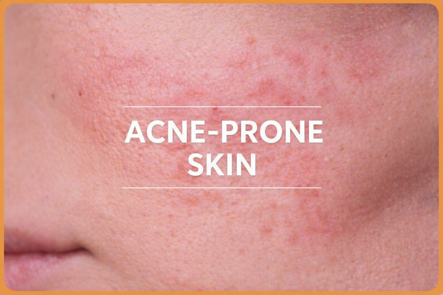 Sunscreen for Acne-Prone Skin